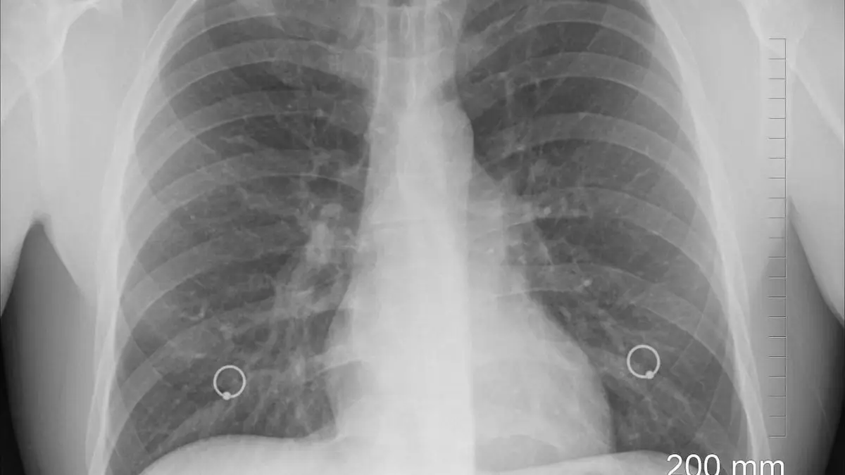 Deep Learning : Google teste une IA pour dépister le cancer du poumon